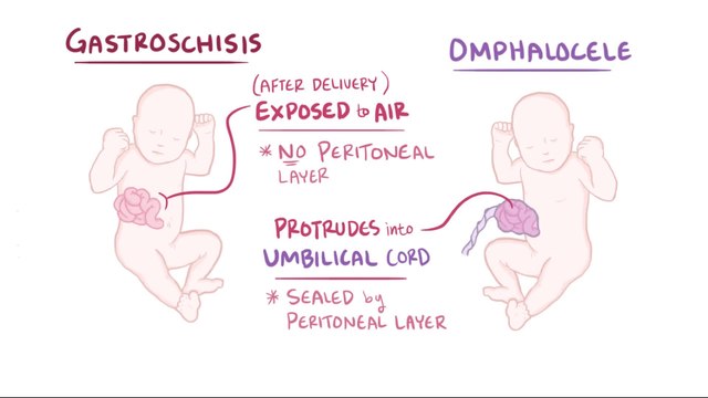 Gastroschisis vs Omphalocele