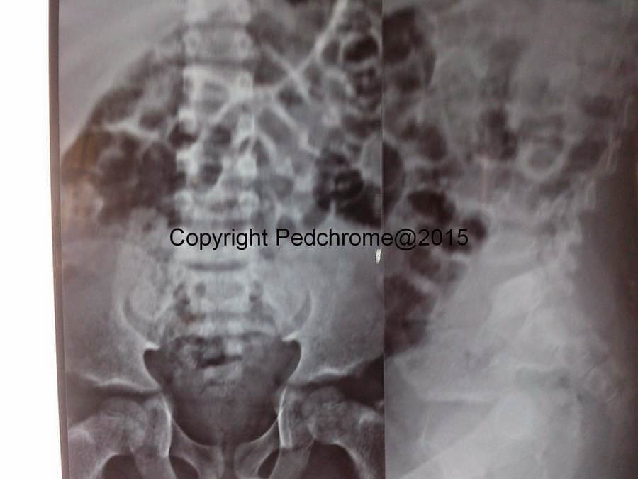 MPS spine xray