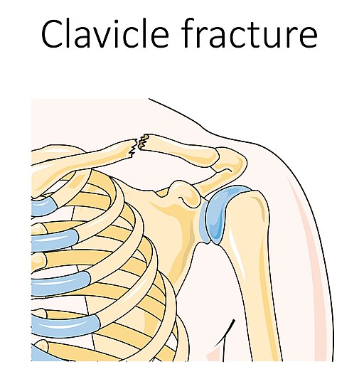 Clavicle fracture
