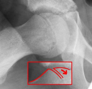 SCFE : Mnemonic Approach | Epomedicine