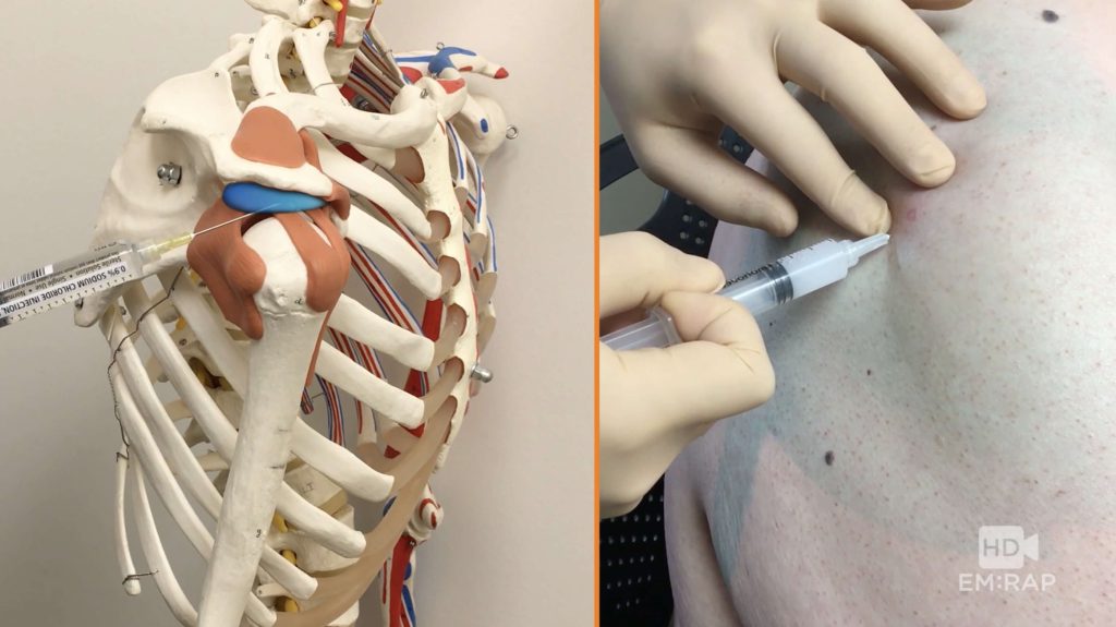 subacromial injection technique