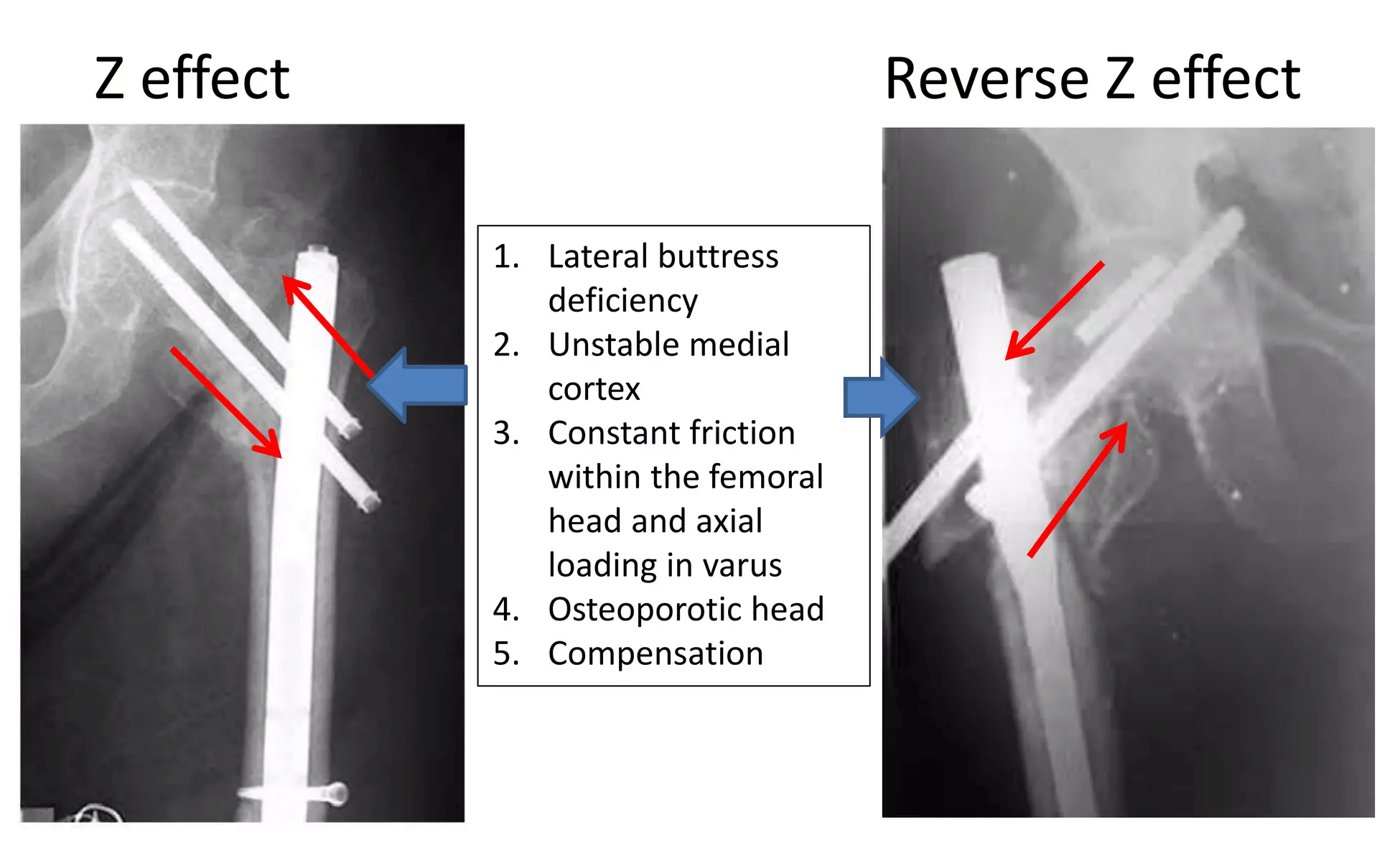 Z Effect And Reverse Z Effect In Pfn Epomedicine