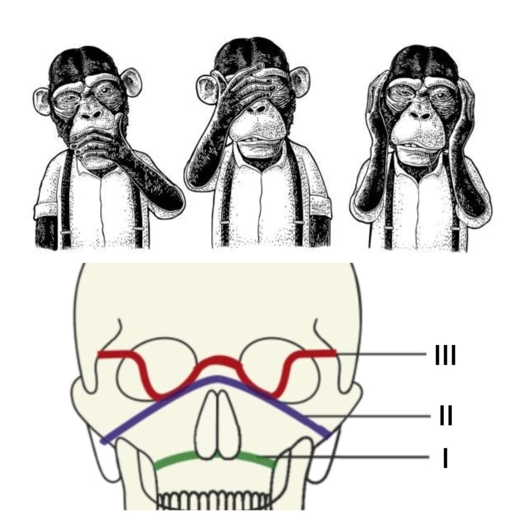 le-fort-fractures-mnemonics-epomedicine