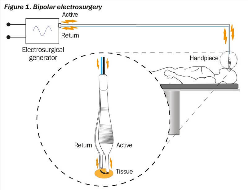 bipolar electrosurgery