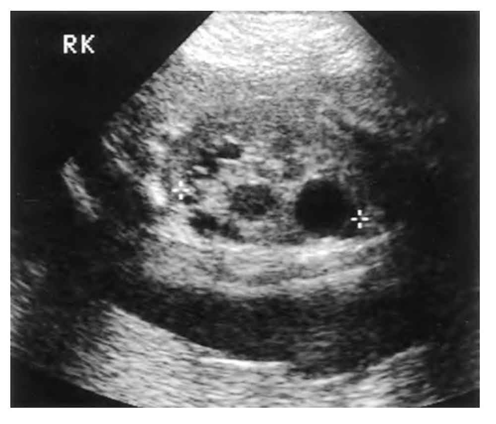 antenatal hydronephrosis ultrasound