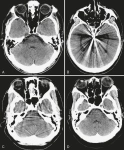 Interpretation of NCCT head: Normal findings | Epomedicine