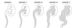 Vesicoureteric reflux (VUR) Grading : Mnemonic | Epomedicine