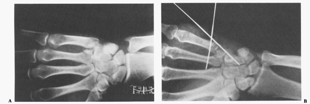 reverse bennett fracture