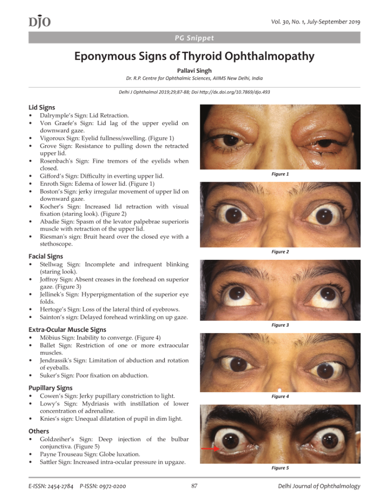 Thyroid eye signs