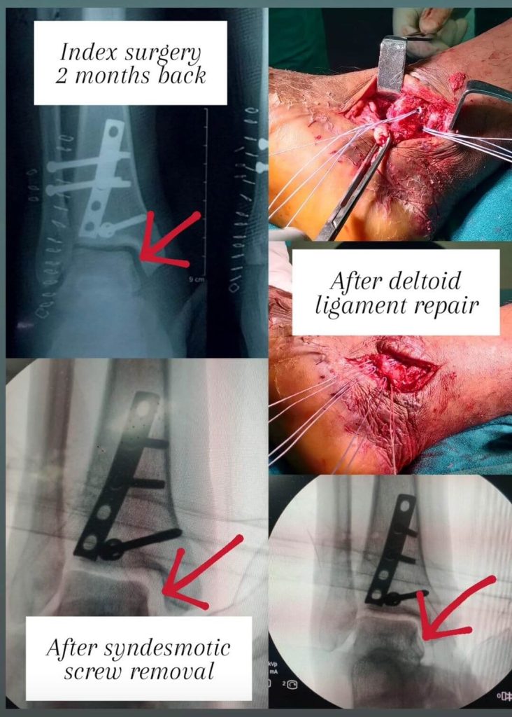 deltoid ligament repair using suture anchors