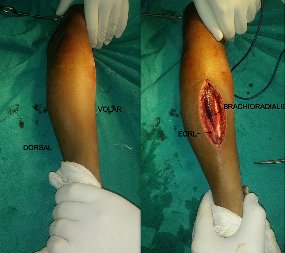 lateral approach to radius