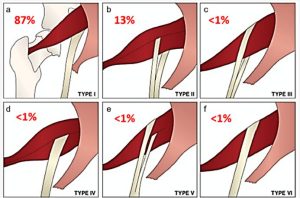 Sciatic Nerve Variations around Piriformis Muscle