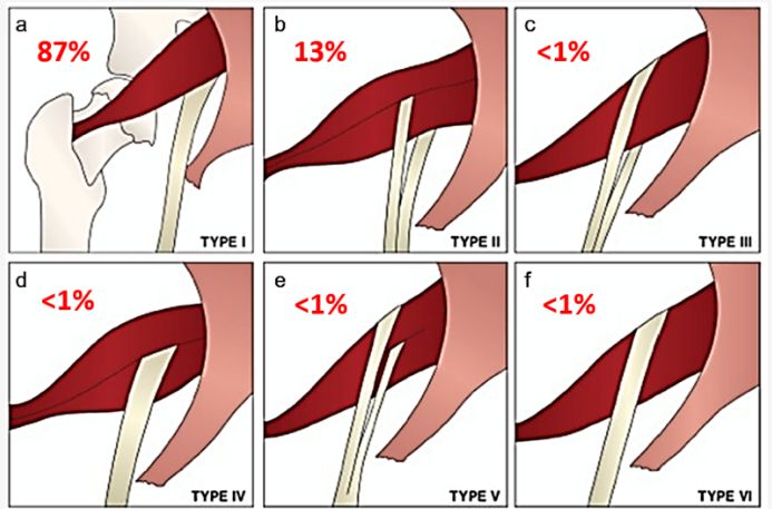 sciatic nerve variations
