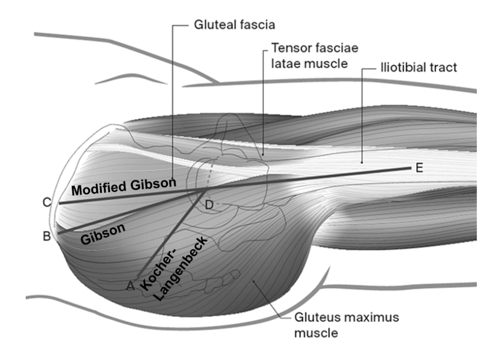 safe surgical dislocation approach