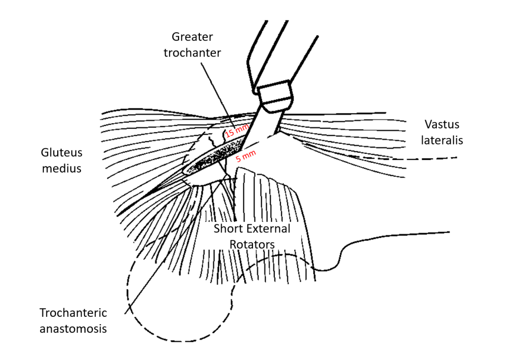 trochanteric digastric osteotomy