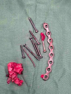 acetabular plate removed