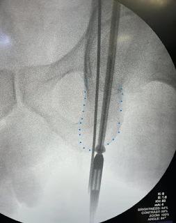 obturator outlet posterior column