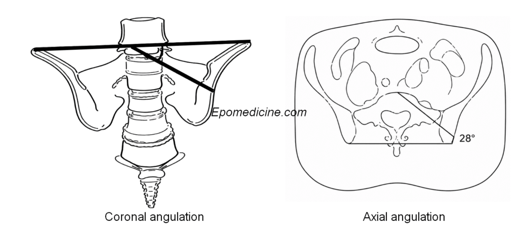 sacral dysmorphism score