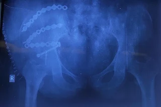 iliac wing fracture postop