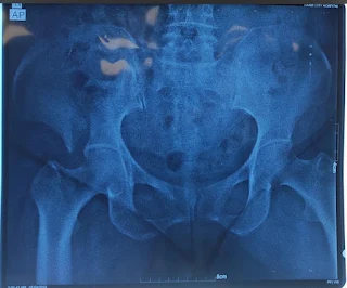 iliac wing fracture preop