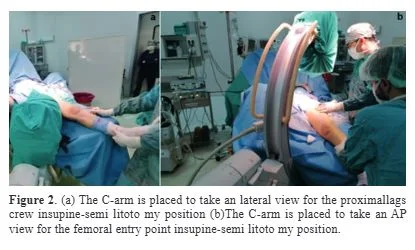 neck of femur supine c-arm