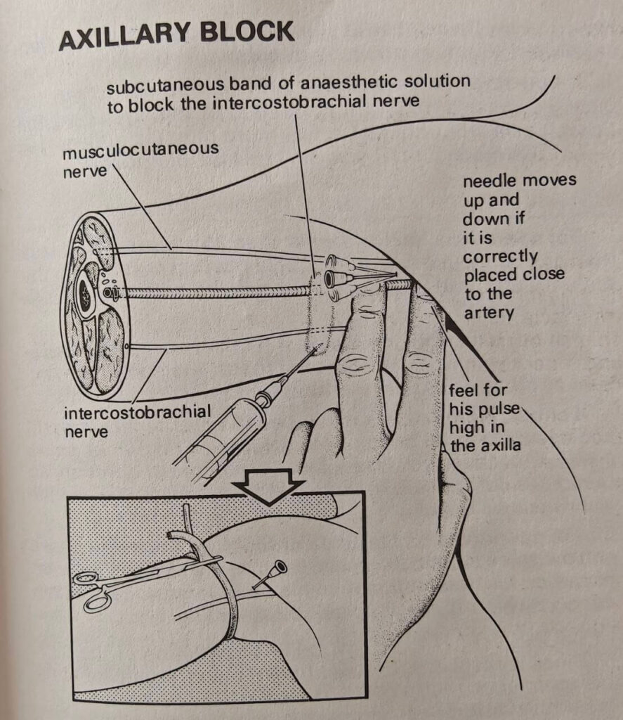 axillary block technique